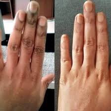 KNUCKLES CORRECTOR SET